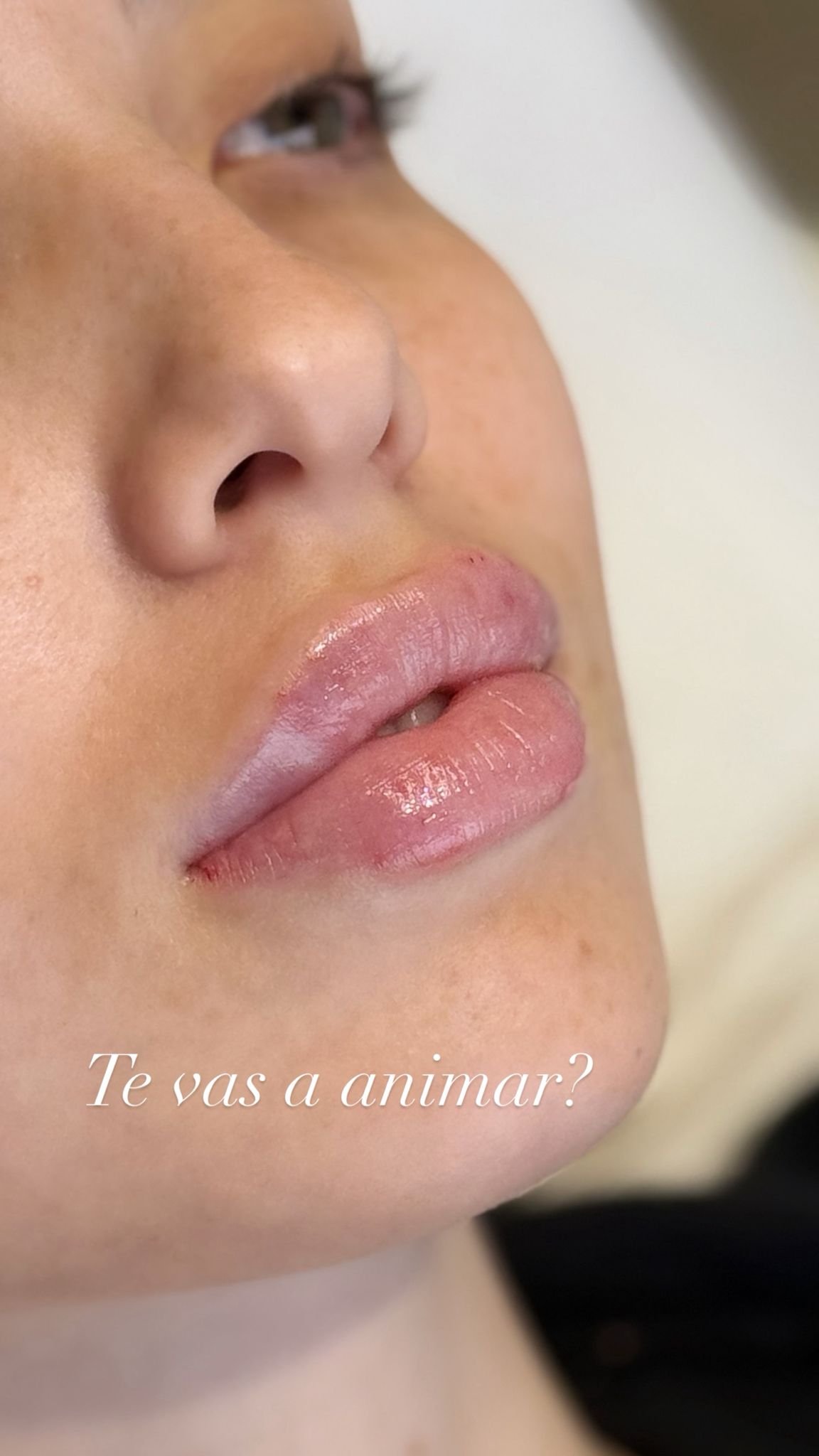 Resultado de armonización facial - Bioestimulación